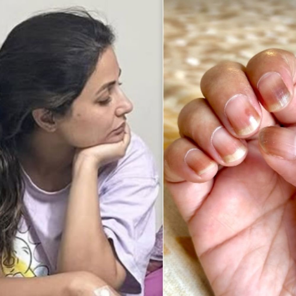 Hina Khan’s nails dried up due to chemotherapy: The actress said, this is a side effect, sometimes these nails also get uprooted, I am happy that all this is temporary