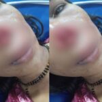 In Karnataka, a man bit his wife’s nose: there was a fight over repaying the loan; in UP, a deputy director cut off an engineer’s nose