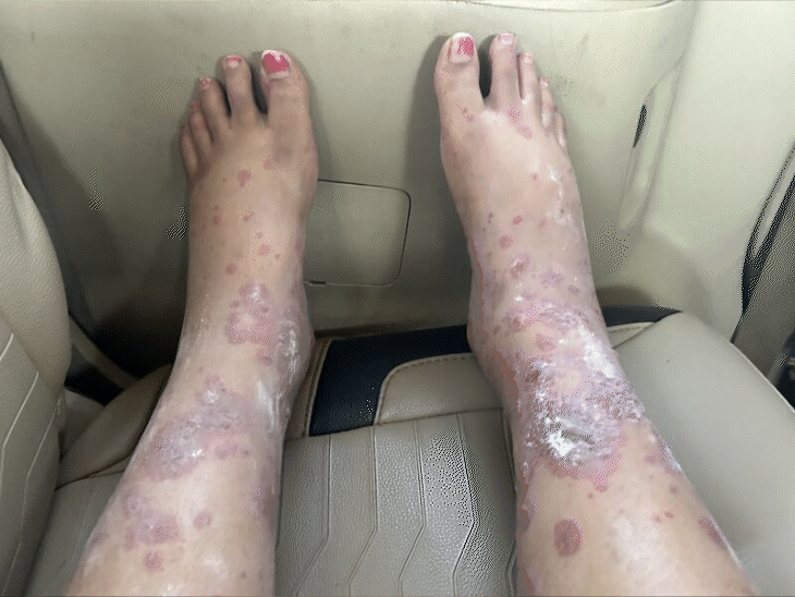 Woman claims she contracted the infection while on an Akasa flight: shares photo of swollen feet; rashes extend below the knee.